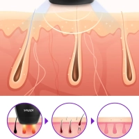 Фотоэпилятор КТ-3129 - 36 Вт
